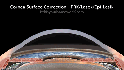 Cornea-Surface-Correction